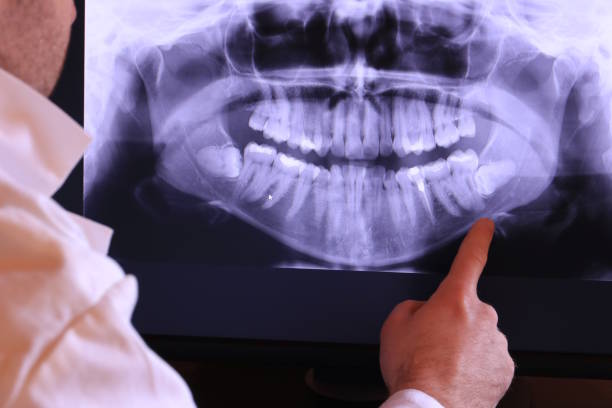 Best Emergency Wisdom Teeth Removal in Forest, VA